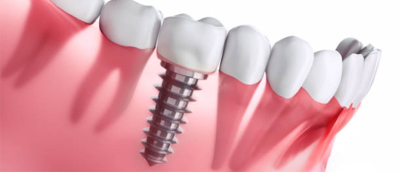 Curso implantes005.jpg AOA